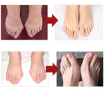Paire de Correcteur Hallux Valgus en Silicone