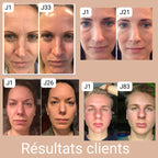 LUMILIFT - Appareil de soin visage luminothérapie